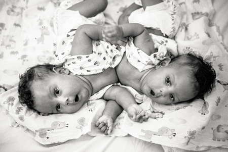 Photographer-Captures-Conjoined-Twins